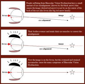 bvd-1-3-all-red-final | Society of NeuroVisual Medicine