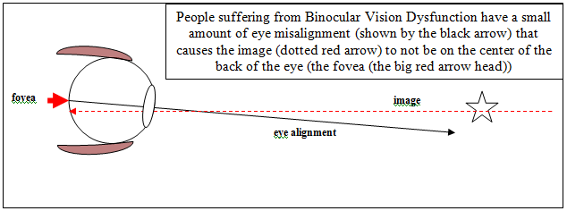 Image 1 - BVD - Visual description of Binocular Vision disorder