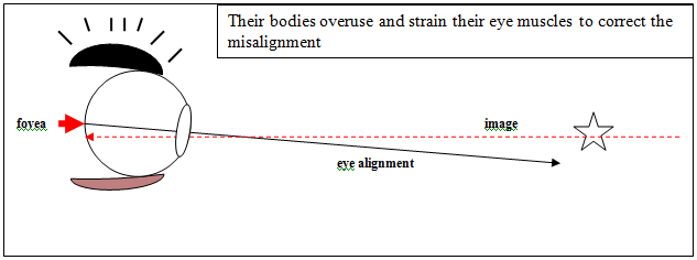 Image 2 - BVD - Visual description of Binocular Vision disorder