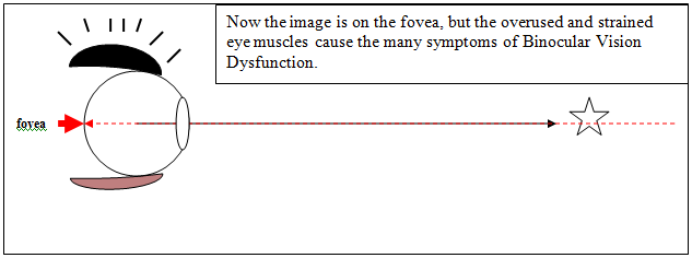 Image 3 - BVD - Visual description of Binocular Vision disorder