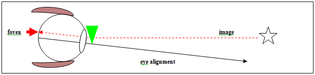 Image 6 - BVD - Visual description of Binocular Vision disorder