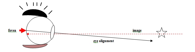 Diagram 2 - BVD - Visual description of Binocular Vision disorder