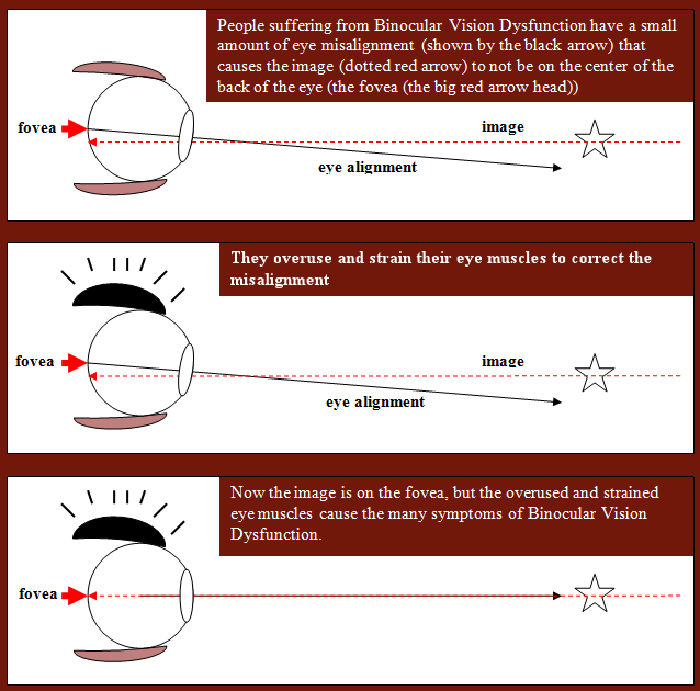 Vision Specialists | Visual description of Binocular Vision disorder