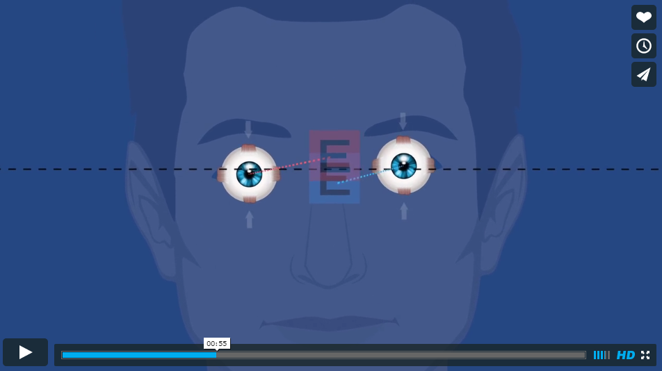 binocular vision dysfunction test