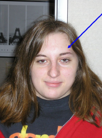 Society of NeuroVisual Medicine demonstration of elevated eyebrow to overcom BVD